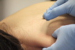 Tratamiento Punción Seca