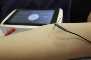 Tratamiento Neuromodulacion transcutanea ecoguiada