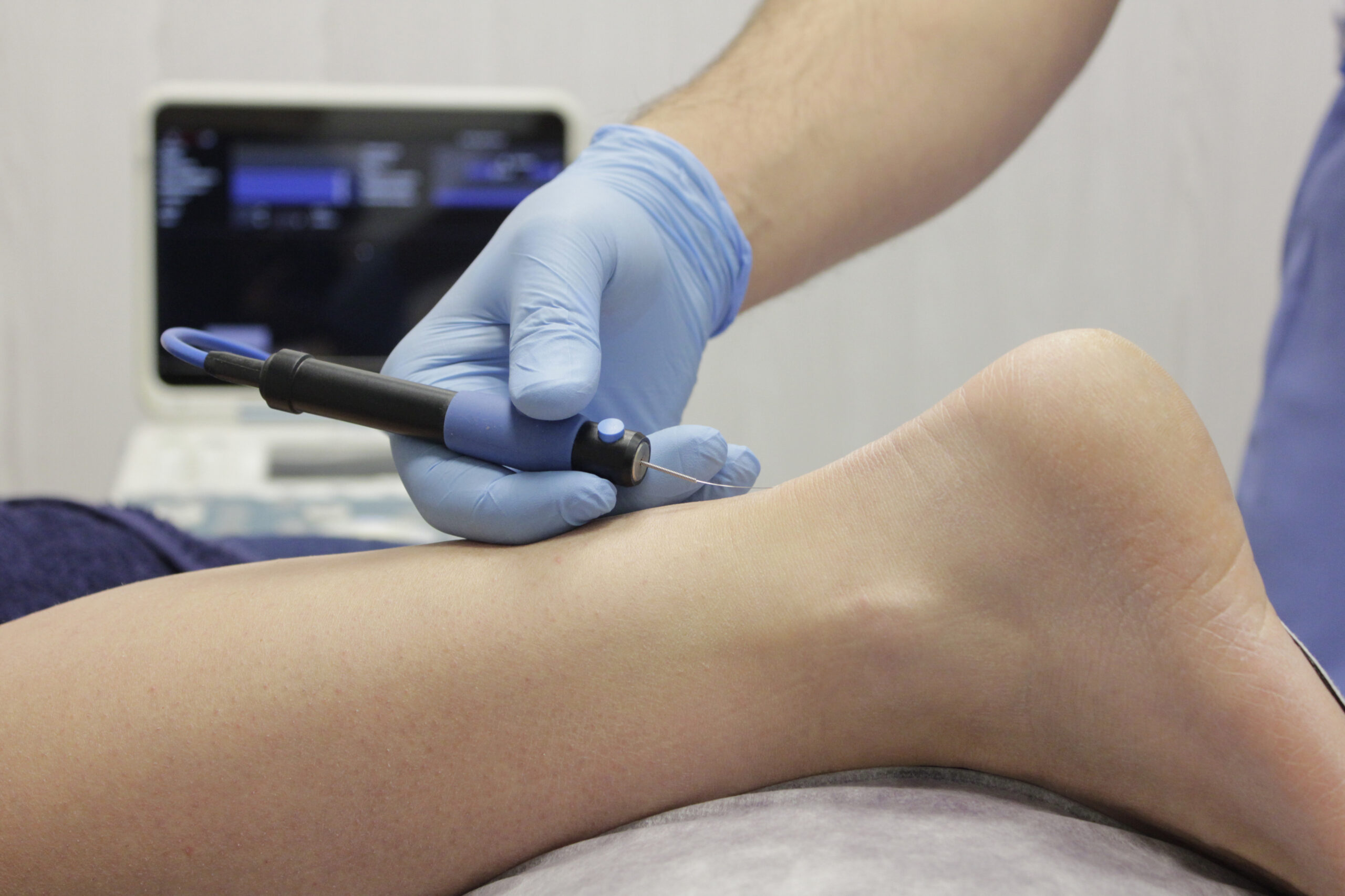 Servicio de Electrolisis percutanea ecoguiada